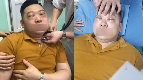 Thái hành nấu ăn, một thanh niên bị sốc phản vệ khiến 2 mắt sưng vù