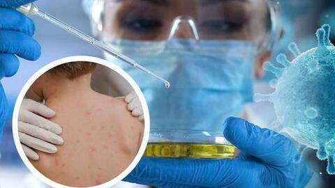 WHO nghiên cứu khả năng đột biến gene thúc đẩy đậu mùa khỉ lây lan