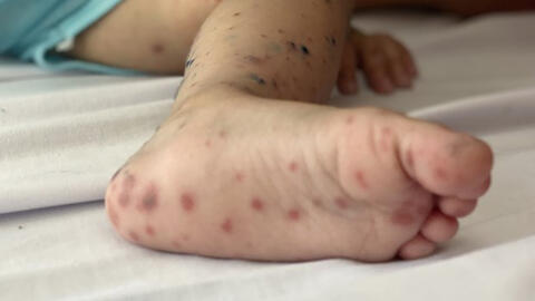 Virus Enterovirus 71 gây bệnh tay chân miệng nặng xuất hiện trở lại​