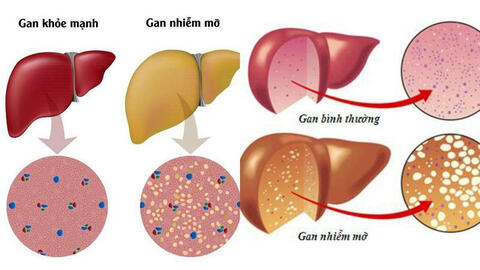 Cần làm gì khi bị gan nhiễm mỡ?