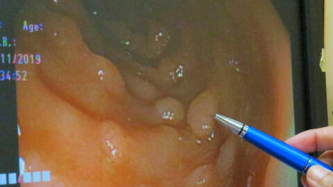 Polyp ở 3 vùng dễ dẫn đến ung thư, 5 thói quen tốt cần làm để tránh