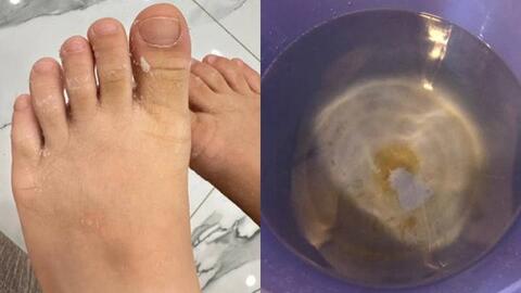 Nước sạch ở khu đô thị Thanh Hà gây mẩn ngứa: Chuyên gia nói về loại độc tố nguy hiểm đến sức khỏe
