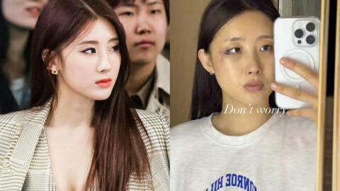 Nữ idol gợi cảm Hyuna phải phẫu thuật, bó bột vì tai nạn không ngờ