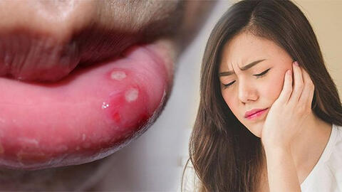Mẹo hay trị bệnh nhiệt miệng nhanh chóng tại nhà