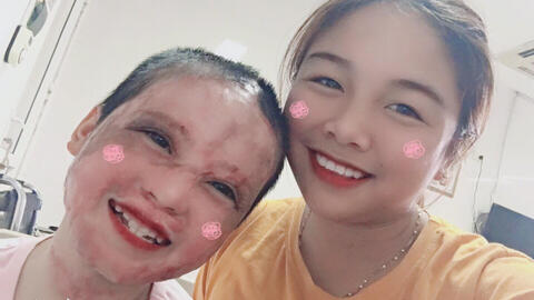 Câu chuyện về cô bé lớp 5 từng bị thiêu sống và nghị lực vươn lên nghịch cảnh sau 4 năm