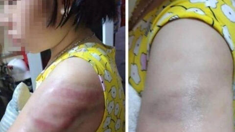 Vụ học sinh bị đánh bầm tím tay vì viết bài chậm: Cô giáo tường trình do mất bình tĩnh