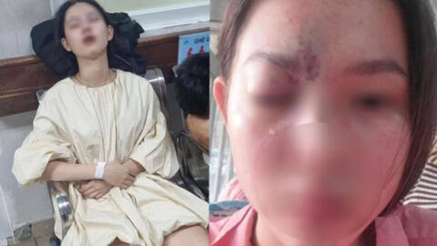 Thiếu nữ 17 tuổi mù mắt vĩnh viễn, liệt nửa não trái sau tiêm filler nâng mũi: Đừng quên 4 điều để an toàn khi làm đẹp