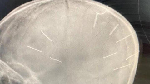 Triệu tập mẹ bé gái có 9 dị vật trong sọ não