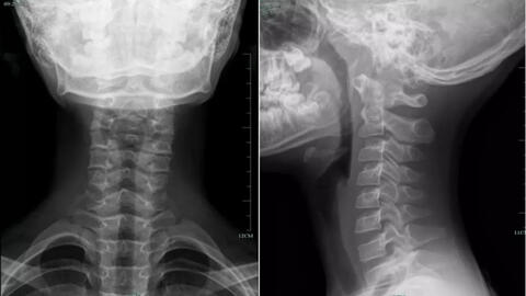 10 tuổi cột sống cổ đã cong vẹo, không cử động được vì thói quen của nhiều người