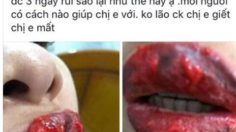 Xăm môi đón Tết, khách hàng dở khóc dở mếu với đôi môi nhiễm trùng