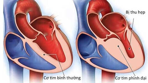 Bộ Y tế bác tin virus lạ viêm cơ tim gây chết nhiều người
