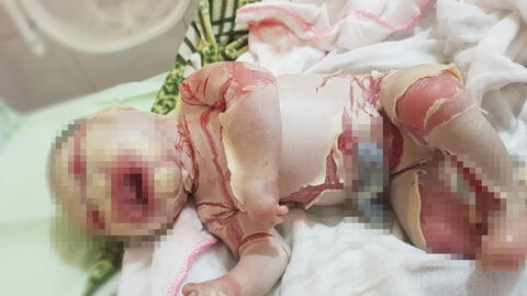 Bé sơ sinh mắc bệnh lạ với lớp vảy trắng bọc toàn thân kèm theo những vết nứt sâu, chảy máu