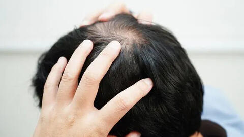 Rụng lông tóc ở ba vùng trên cơ thể có thể là dấu hiệu của bệnh truyền nhiễm