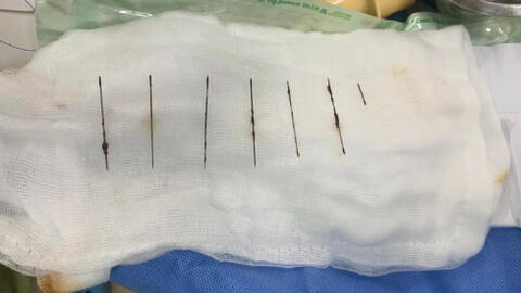 Thanh niên 28 tuổi tự đâm 7 cây kim khâu vào ngực
