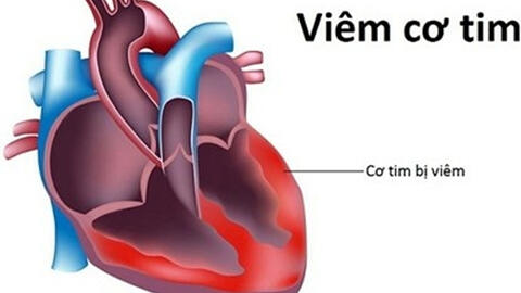 Thực hư virus viêm cơ tim gây chết người đang xôn xao cộng đồng mạng