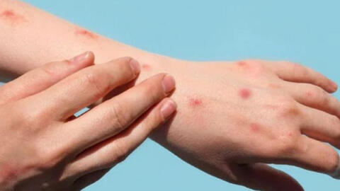 Những đối tượng nào cần tiêm chủng vaccine đậu mùa khỉ?