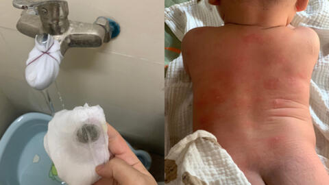 Sở Xây dựng Hà Nội lên tiếng vụ hàng trăm cư dân nổi mẩn ngứa, bong tróc da khi dùng nước sinh hoạt