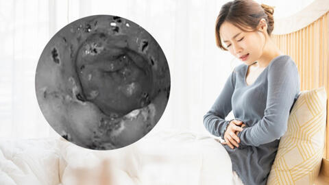 Dạ dày người phụ nữ "thủng" đến 30 vết chỉ do một sơ suất, có vấn đề đường tiêu hoá đặc biệt lưu ý