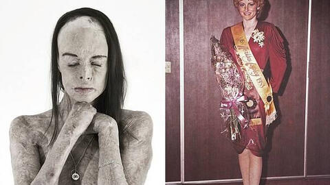 Hành trình tái sinh của Hoa hậu bị bỏng 85% cơ thể: "Tôi sống trong làn da ấy"