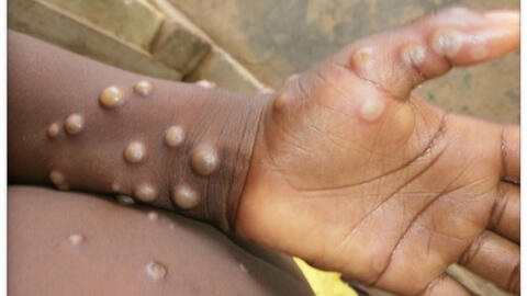 Bệnh đậu mùa khỉ diễn biến phức tạp, Việt Nam tăng cường theo dõi, giám sát