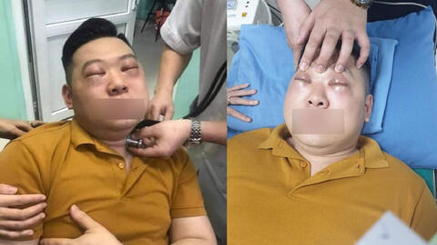 Thái hành nấu ăn, một thanh niên bị sốc phản vệ khiến 2 mắt sưng vù