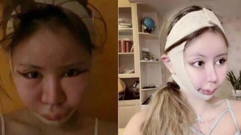 Bé gái 9 tuổi bị mẹ bắt cắt mí, làm mũi