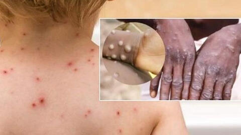 Mỹ phối hợp với Việt Nam phòng chống và kiểm soát dịch bệnh đậu mùa khỉ