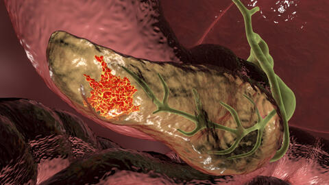 1 dấu hiệu sớm cảnh báo ung thư tuyến tụy: 75% bệnh nhân có triệu chứng này