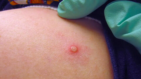 Việt Nam phát hiện ca đậu mùa khỉ thứ hai