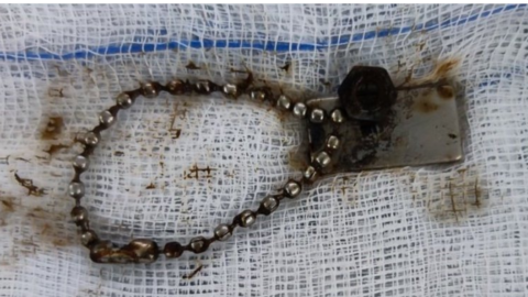 Bé trai 6 tuổi bị thủng ruột do nuốt miếng nam châm