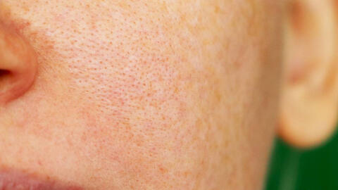 Lỗ chân lông như thế nào được gọi là bình thường?