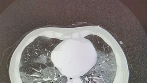 Bức thư đau đớn của bác sỹ người Ý giữa tâm dịch Covid-19