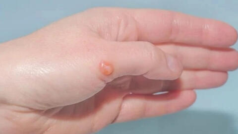 Virus đậu mùa khỉ đang tiến hóa?