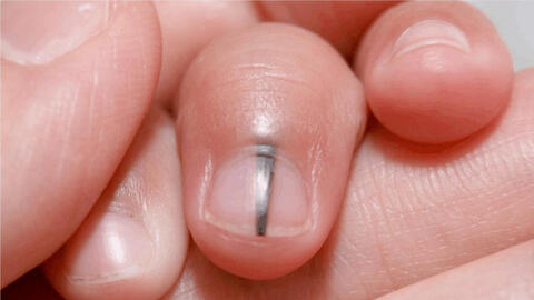 6 dấu hiệu cảnh báo trước khi ung thư ập đến, ít ai chú ý tới