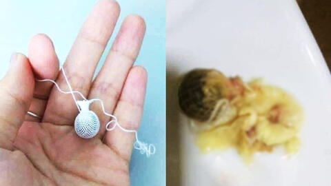 Chuyên gia nói gì về loại "kén" được quảng cáo chữa tất cả các bệnh phụ khoa?