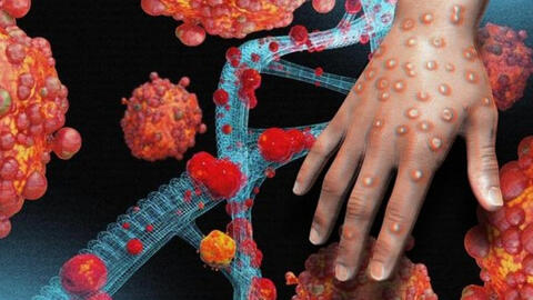 TP.HCM ghi nhận ca đậu mùa khỉ đầu tiên