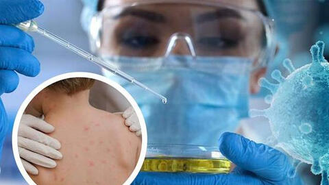 WHO nghiên cứu khả năng đột biến gene thúc đẩy đậu mùa khỉ lây lan