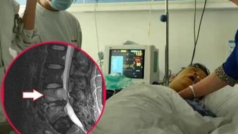 Đau lưng nên khám xương khớp, ai ngờ bị ung thư phổi “ăn mòn” 2 đốt sống