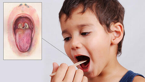 Bệnh bạch hầu làm 2 người tử vong nguy hiểm thế nào?