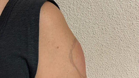 ‘Cánh tay COVID’ – tác dụng phụ hiếm gặp sau tiêm vaccine COVID-19