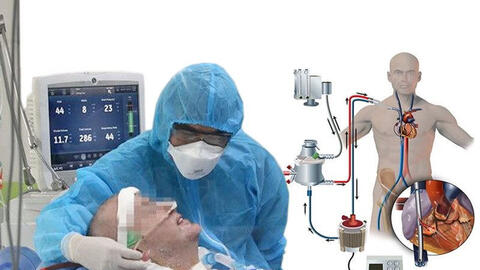 ECMO là gì, TP.HCM có thiếu máy ECMO không?