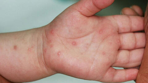 Trẻ bị tay chân miệng cần ăn uống ra sao để tăng sức đề kháng?