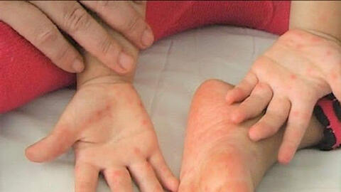 Số ca bệnh tay chân miêng tăng 4 lần so cùng kỳ năm ngoái