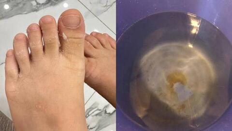 Nước sạch ở khu đô thị Thanh Hà gây mẩn ngứa: Chuyên gia nói về loại độc tố nguy hiểm đến sức khỏe