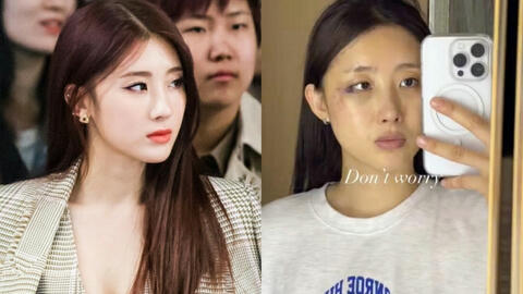 Nữ idol gợi cảm Hyuna phải phẫu thuật, bó bột vì tai nạn không ngờ