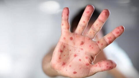 Hơn 300 ca mắc bệnh tay chân miệng từ đầu năm đến nay