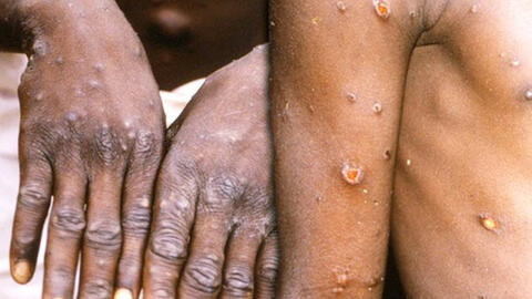 Ca tử vong đầu tiên do bệnh đậu mùa khỉ tại Tây Ban Nha
