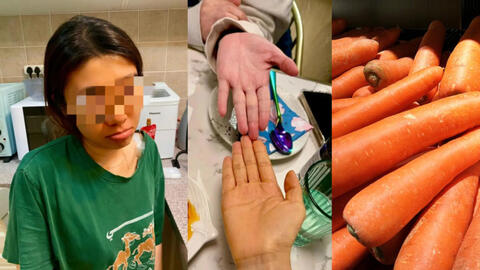Ăn cà rốt liên tục 3 tháng để giảm cân, cô gái da chuyển vàng như nghệ