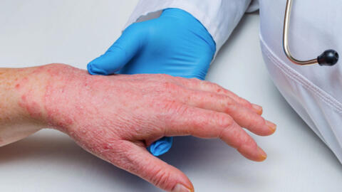 Bộ Y tế yêu cầu giám sát 21 ngày người nhập cảnh từ nơi có đậu mùa khỉ