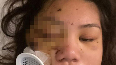 Một cô gái gốc Á bị bắn vào mặt ở Mỹ